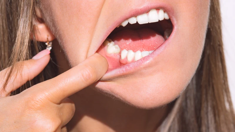 Diş Eksikliği Tedavi Yöntemleri İçin Bekleyen Kadın