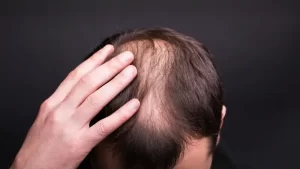 saç ekimi sonuçları görülen hasta