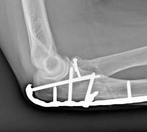 dirsek röntgen görüntüsü