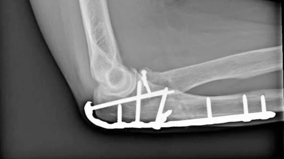 dirsek röntgen görüntüsü