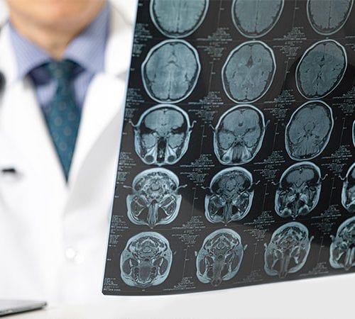 Dural Arteriovenöz Fistül (DAVF)