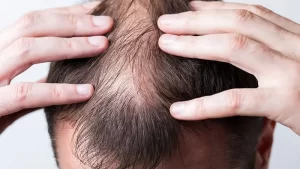 Erkek Tipi Saç Dökülmesi