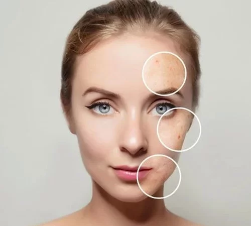 cilt-lekeleri-e Cilt lekeleri problemi yaşayan kadın