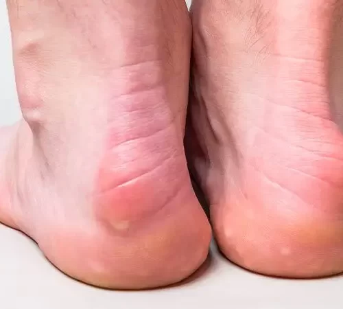 deformite-cerrahisi-m deformite cerrahisi uygulanacak topuk