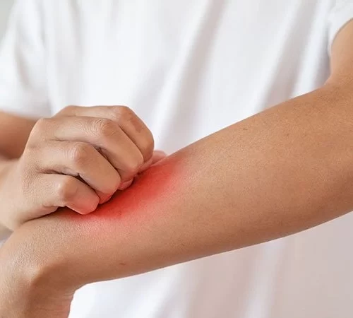 dermatolojik-mantar-e Dermatolojik Mantar Hastalıkları Sorunu Yaşayan Kişi