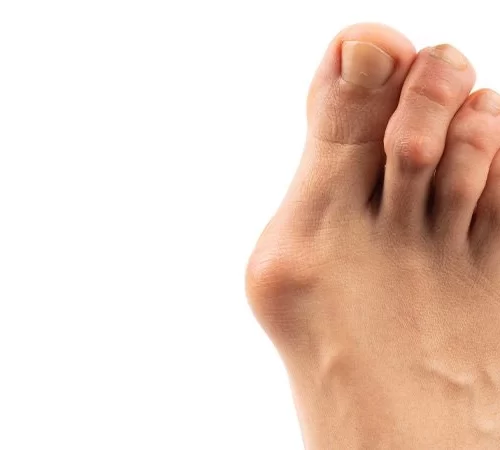 Halluks Valgus Problemli Ayak