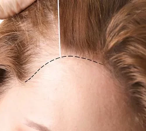 kadinlarda-sac-ekimi-m Kadınlarda Saç Ekimi ve Donör Bölgenin Önemi