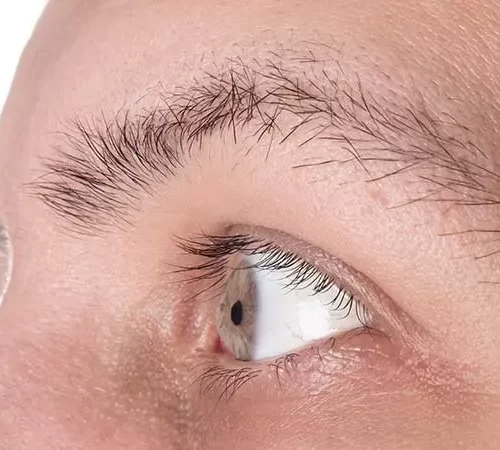 keratokonus-ameliyati-e Keratokonus ameliyatı olması gereken adam