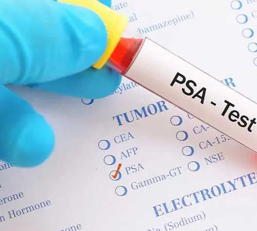 prostat-spesifik-antijen-m PSA (Prostat Spesifik Antijen)