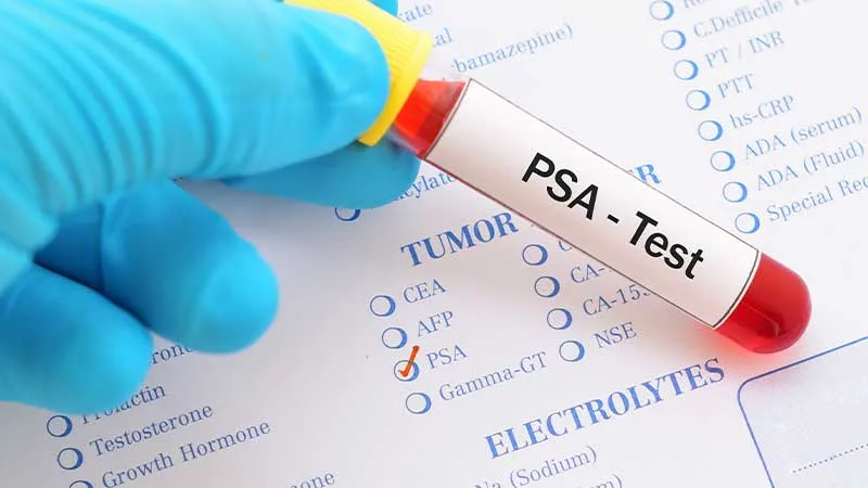 PSA (Prostat Spesifik Antijen)