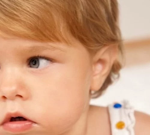 sasilik-e Şaşılık (Gözlerde Kayma) hastası çocuk