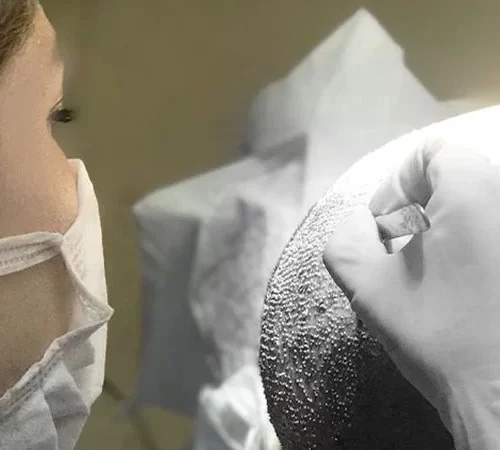 soft-fue-sac-ekimi-m soft fue saç ekimi yapan uzman