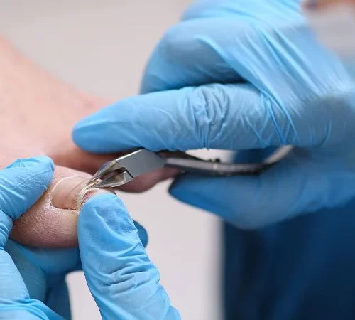 tirnak-mantari-e Tırnak Mantarı Tedavisi