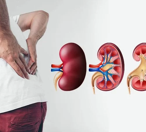 böbrek ve idrar yolu taşları sırt ağrısı yaşayan adam