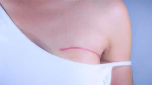 mastektomi ameliyatı göğsü çizilmiş kadın