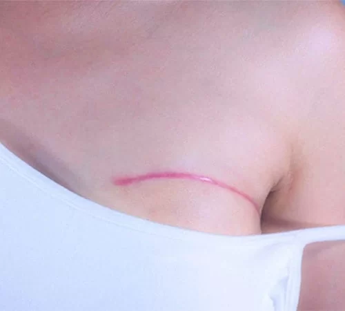 mastektomi ameliyatı göğsü çizilmiş kadın