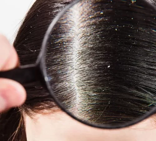 Saçta kepek sorunu yaşayan kadın