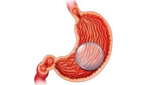 إدخال بالون داخل المعدة (Intragastric balloon)