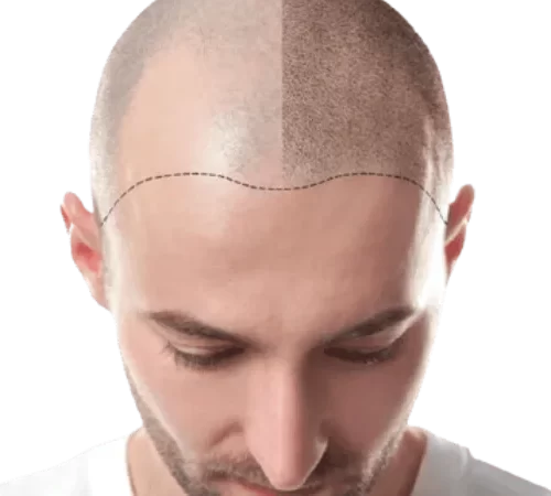 sac-ekimi-oncesi-sonrasi-m erkek saç ekimi öncesi sonrası görünümü
