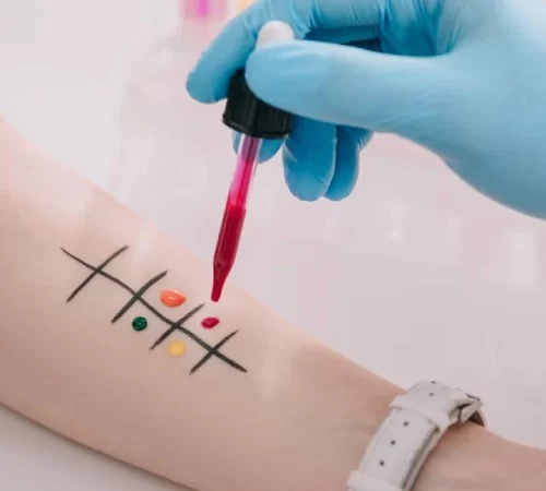 Alerji ve İmmunoloji hastalıkları için alerji testi