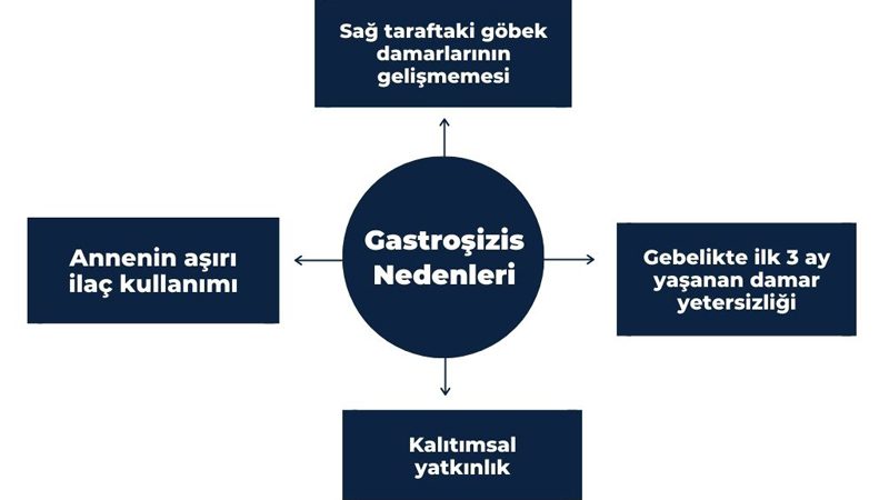 Gastroşizis Nedenleri