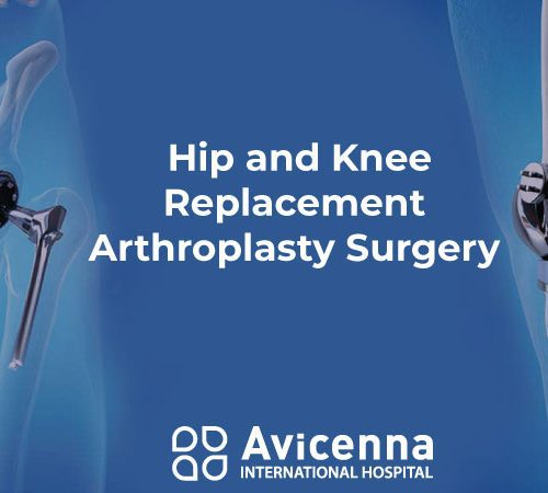 Hip and Knee Replacement – Arthroplasty Surgery