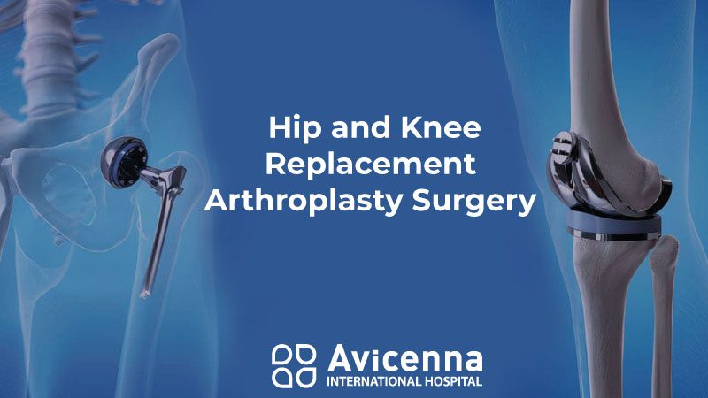 Hip and Knee Replacement – Arthroplasty Surgery