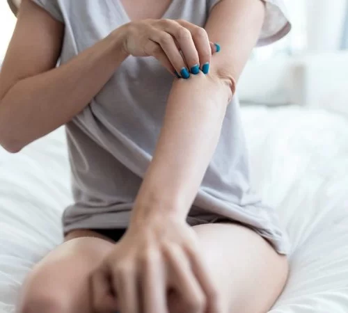 uyuz-hastaligi-e Uyuz hastalığı belirtileri taşıyan kadın