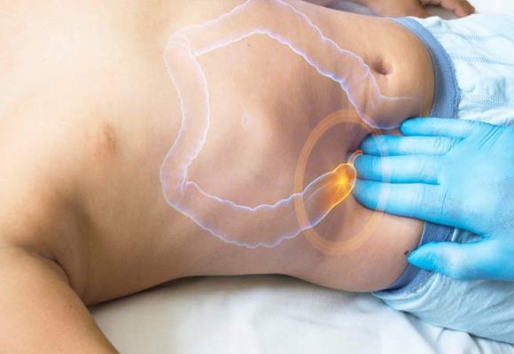 What Should You Pay Attention To After Appendix Removal Surgery?