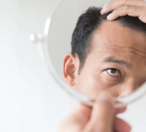 saç ekimi operasyonu riskleri aynada saçına bakan adam