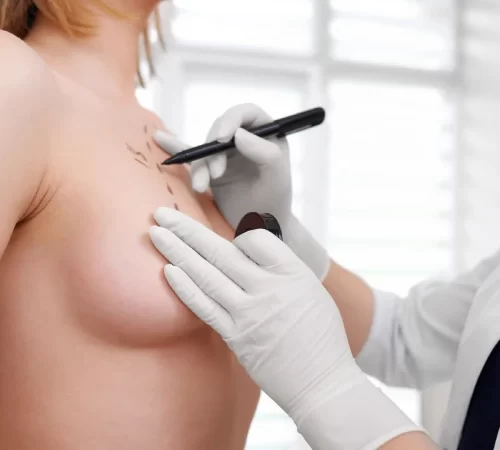 Breast Augmentation Surgery