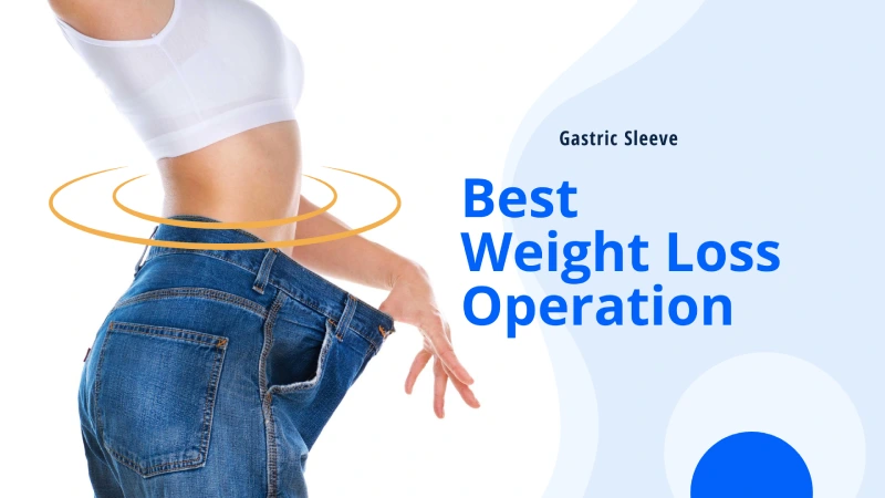 Best Weight Loss Operation: Gastric Sleeve