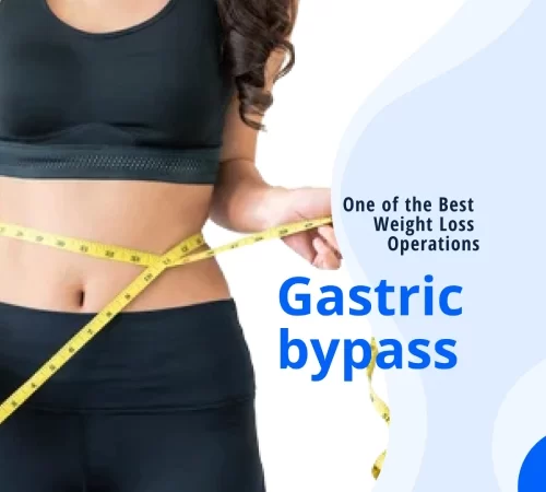 Gastric bypass