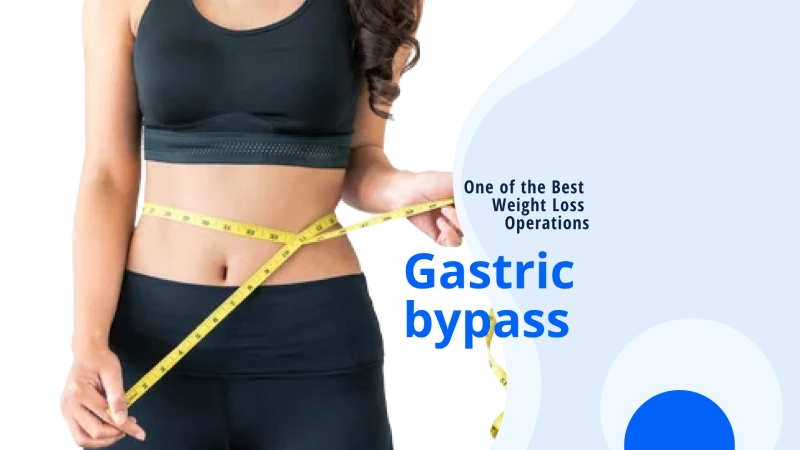 Gastric bypass