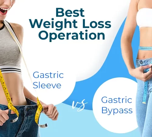 Gastric Sleeve VS Gastric Bypass