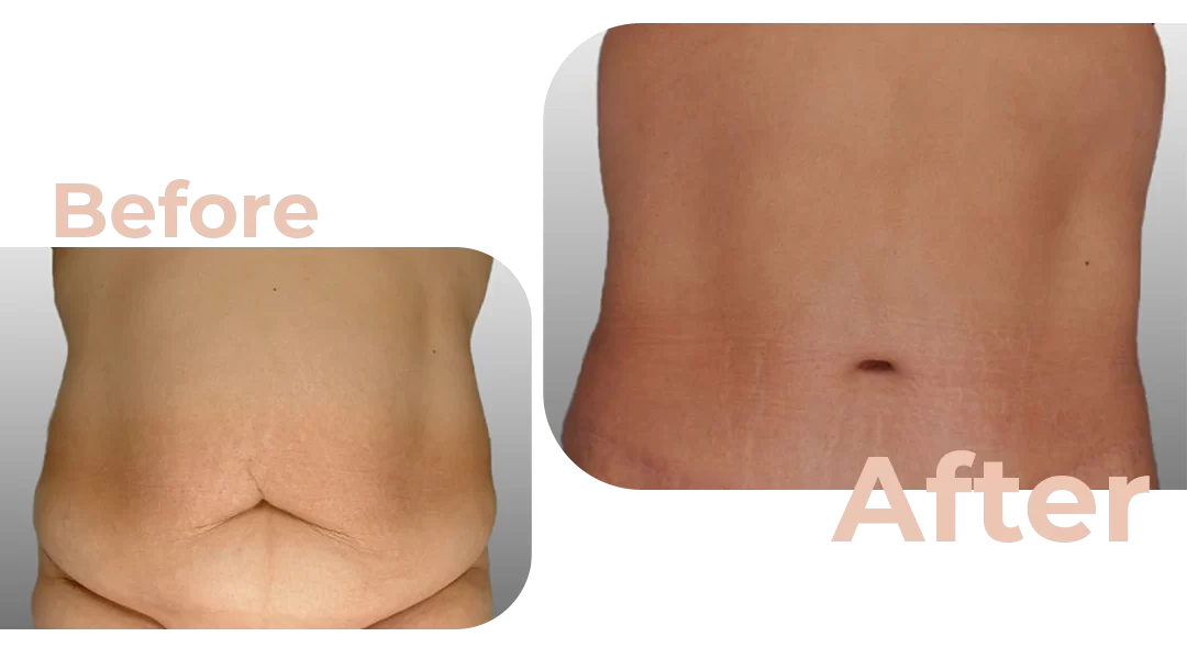 Tummy Tuck Before & After - Ary Krau MD