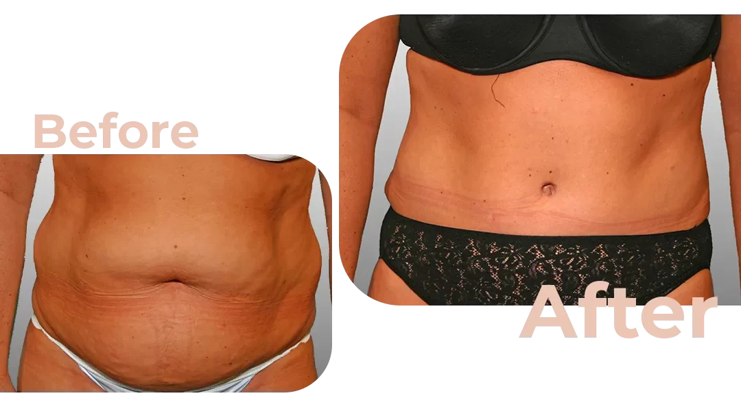 Tummy Tuck Surgery Before and After Photos