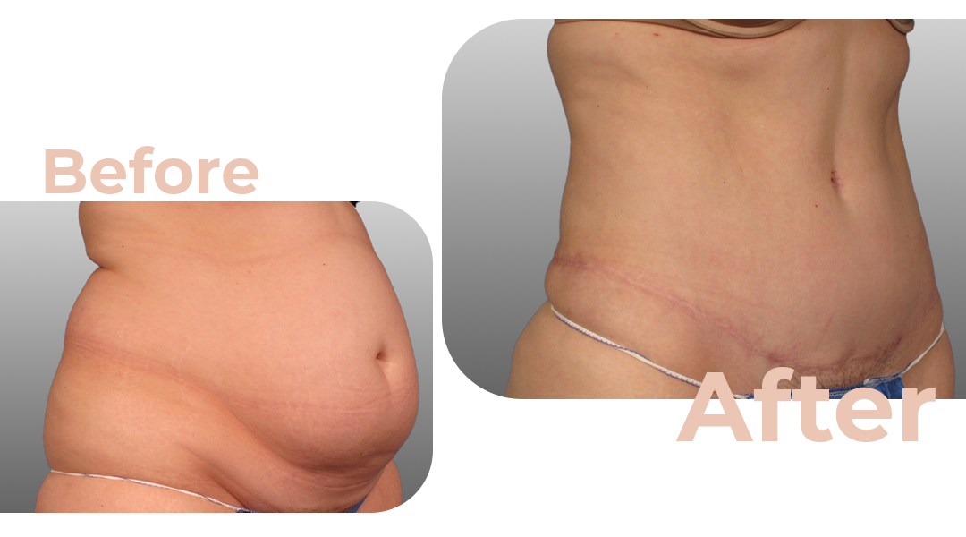 Scarless Tummy Tuck  Avana Plastic Surgery