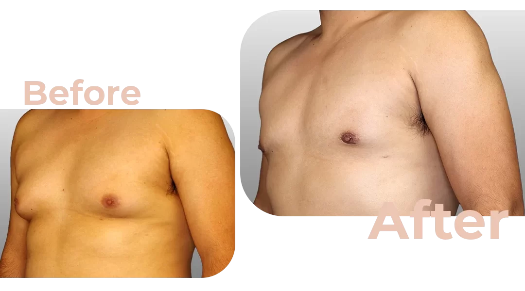 Male Breast Reduction Surgery Before And After Photos Avicenna Hospital 