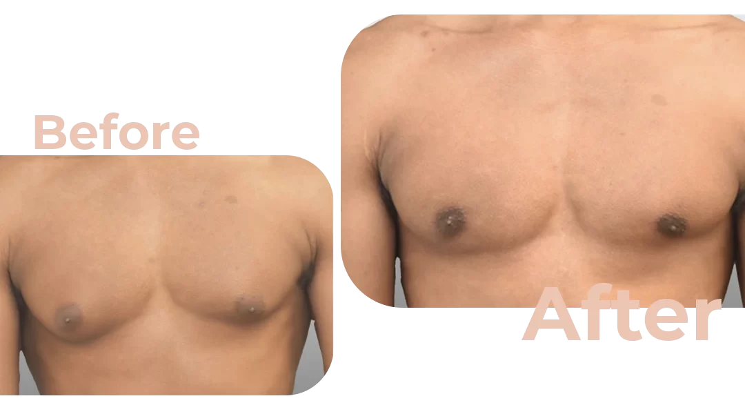 Male Breast Reduction Surgery Before And After Photos Avicenna Hospital 