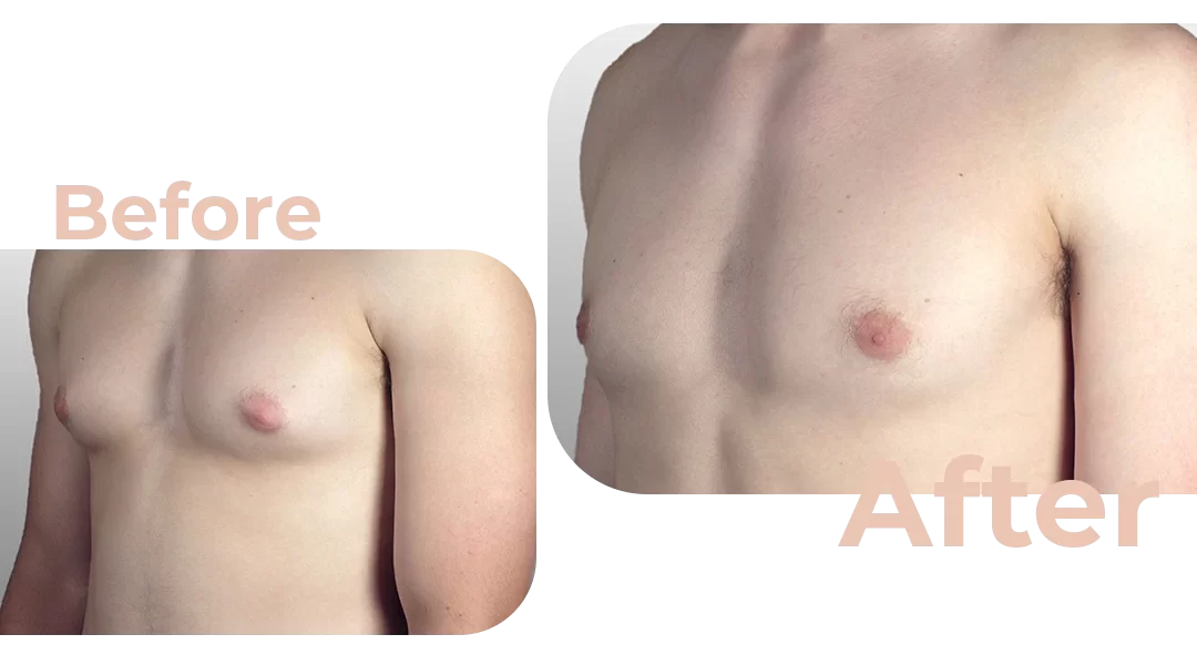 Breast Reduction Surgery : Before and After Photos