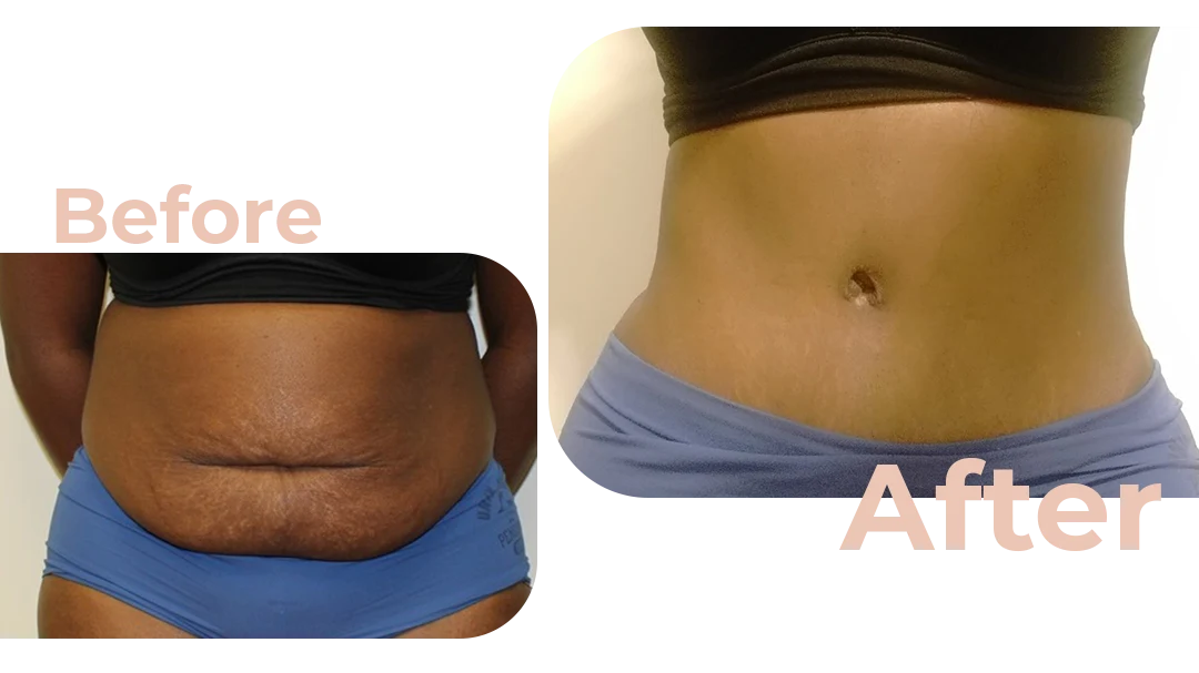 Tummy Tuck Surgery Before and After Photo