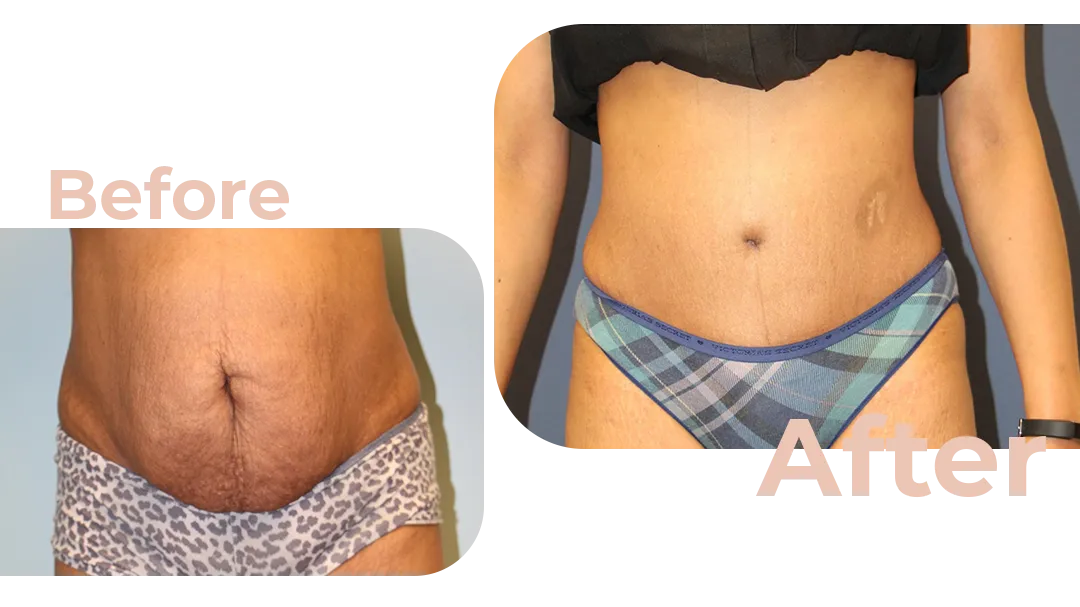 Tummy Tuck Surgery Before and After Photos