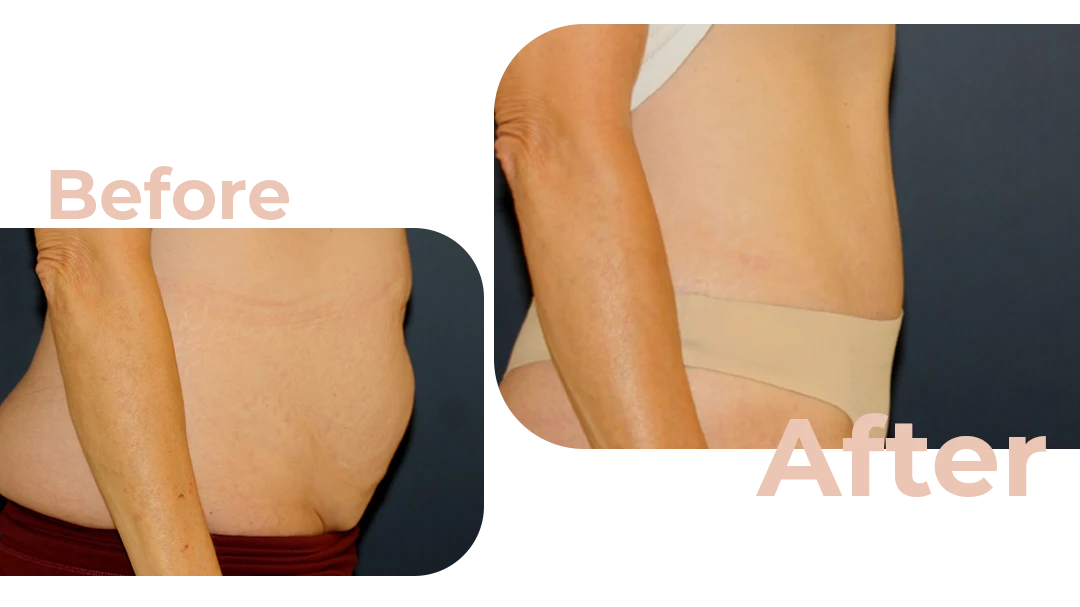 Tummy Tuck Surgery Before and After Photo