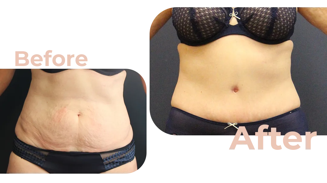 Tummy Tuck Surgery Before and After Photo