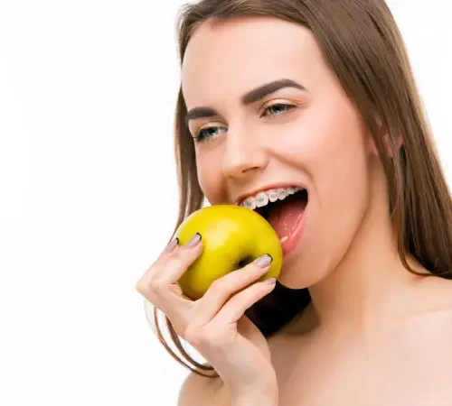 Damon Sistem ile Diş Teli Tedavisi uygulanan kadın