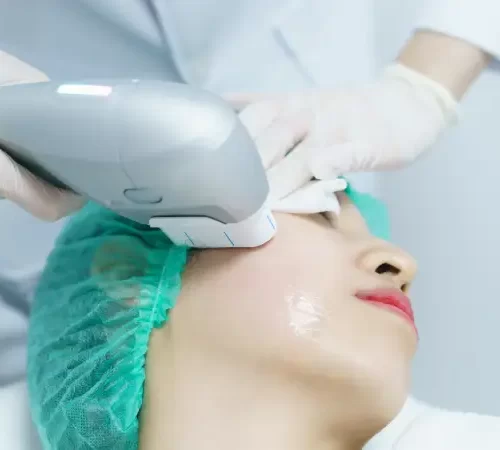 hifu ameliyatsız yüz germe yapılan kadın