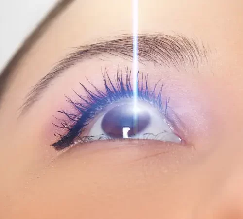 İki Kez Lazer Göz Ameliyatı olan kadın