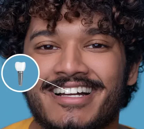 implant tedavisi ne kadar sürer