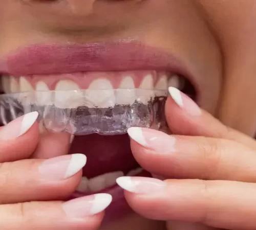 invisalign şeffaf diş teli tedavisi gören kadın